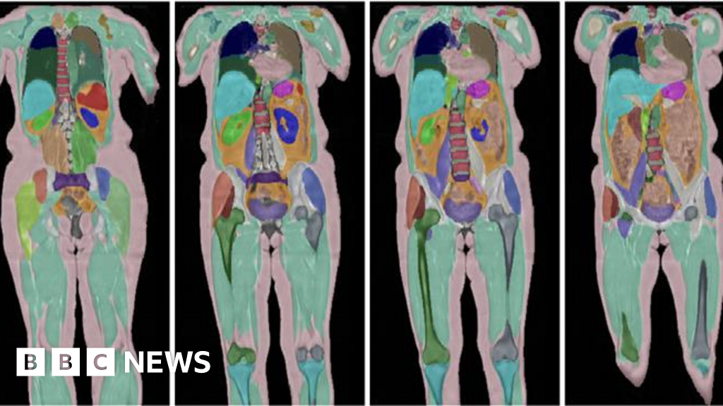 Biggest human imaging study scans 100,000th person