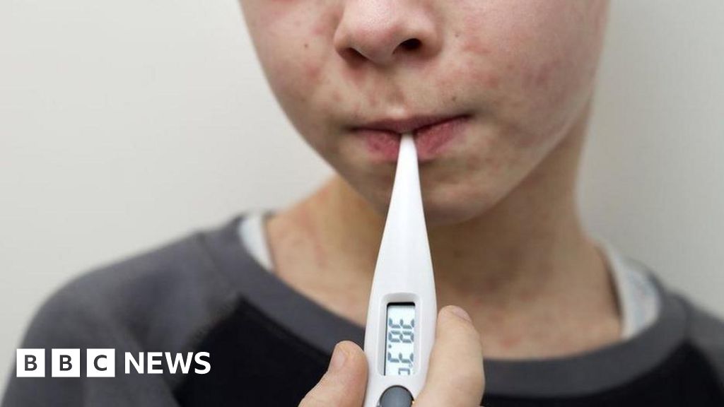 Why are measles cases rising in the UK?